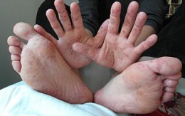 330px-Hand_Foot_Mouth_Disease_Adult_36Years.jpg